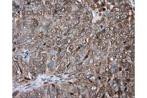 Immunohistochemical staining of paraffin-embedded Adenocarcinoma of ovary tissue using anti-PRKAR2A mouse monoclonal antibody. (PRKAR2A antibody)