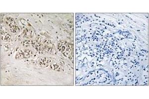 Immunohistochemistry analysis of paraffin-embedded human breast carcinoma, using RAD54B Antibody. (RAD54B antibody  (AA 241-290))