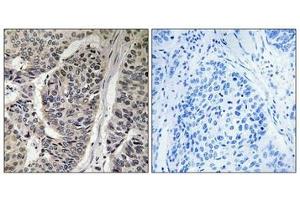 Immunohistochemical analysis of paraffin-embedded human breast carcinoma tissue, using p130 Cas (Phospho-Tyr410) antibody (left)or the same antibody preincubated with blocking peptide (right). (BCAR1 antibody  (pTyr410))