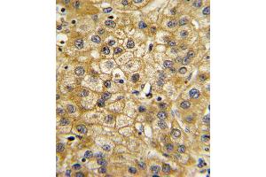 Formalin-fixed and paraffin-embedded human hepatocarcinoma with ADIPOR1 Antibody , which was peroxidase-conjugated to the secondary antibody, followed by DAB staining.