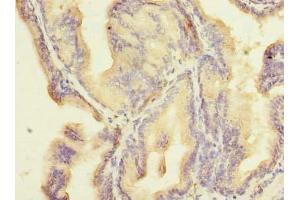 Immunohistochemistry of paraffin-embedded human prostate cancer using ABIN7176433 at dilution of 1:100 (ZNF614 antibody  (AA 1-198))