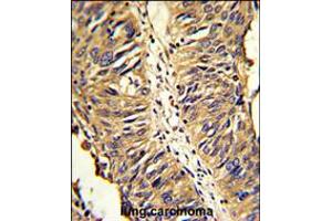 Formalin-fixed and paraffin-embedded human lung carcinoma reacted with PDIA3 Antibody , which was peroxidase-conjugated to the secondary antibody, followed by DAB staining. (PDIA3 antibody  (AA 192-220))