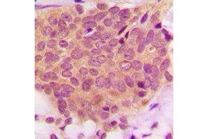 Immunohistochemical analysis of Ezrin/Radixin/Moesin  staining in human breast cancer formalin fixed paraffin embedded tissue section. (Ezrin antibody  (C-Term))
