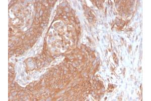 Formalin-fixed, paraffin-embedded human Pancreatic Cancer stained with Spectrin beta III Rabbit Recombinant Monoclonal (SPTBN2/2894R). (Recombinant Spectrin, Beta, Non-erythrocytic 2 (SPTBN2) (AA 356-475) antibody)