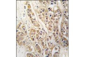 Formalin-fixed and paraffin-embedded human breast carcinoma tissue reacted with CLIC4 antibody, which was peroxidase-conjugated to the secondary antibody, followed by DAB staining. (CLIC4 antibody)