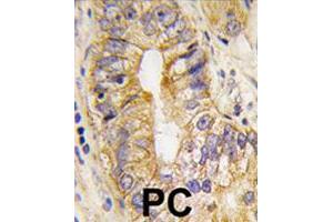 Formalin-fixed and paraffin-embedded human prostate carcinoma tissue reacted with PDGFRA polyclonal antibody  , which was peroxidase-conjugated to the secondary antibody, followed by DAB staining. (PDGFRA antibody  (Tyr768))
