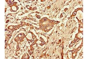Immunohistochemistry of paraffin-embedded human pancreatic cancer using ABIN7172270 at dilution of 1:100 (TLR3 antibody  (AA 135-297))