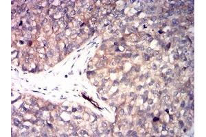 Immunohistochemical analysis of paraffin-embedded bladder cancer tissues using RRM1 mouse mAb with DAB staining.