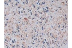 Detection of ADAM17 in Human Prostate cancer Tissue using Monoclonal Antibody to A Disintegrin And Metalloprotease 17 (ADAM17) (ADAM17 antibody  (AA 226-473))
