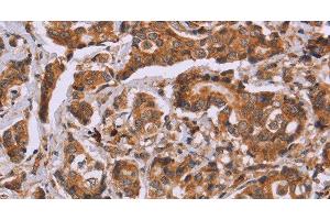 Immunohistochemistry of paraffin-embedded Human breast cancer tissue using CALCA Polyclonal Antibody at dilution 1:40 (CGRP antibody)
