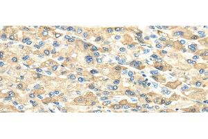 Immunohistochemistry of paraffin-embedded Human liver cancer using INHBB Polyclonal Antibody at dilution of 1/40 (INHBB antibody)