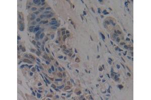 Used in DAB staining on fromalin fixed paraffin- embedded breast cancer tissue (Anoctamin 2 antibody  (AA 823-1003))