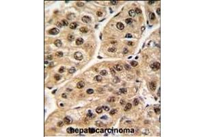 Formalin-fixed and paraffin-embedded human hepatocarcinoma tissue reacted with POLR1C antibody (C-term) (ABIN389351 and ABIN2839457) , which was peroxidase-conjugated to the secondary antibody, followed by DAB staining. (POLR1C antibody  (C-Term))