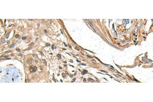 Immunohistochemistry of paraffin-embedded Human esophagus cancer tissue using MAPK4 Polyclonal Antibody at dilution of 1:35(x200)