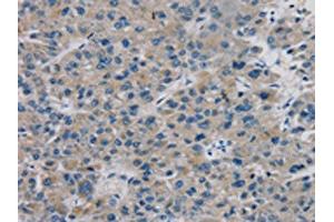 The image on the left is immunohistochemistry of paraffin-embedded Human liver cancer tissue using ABIN7131311(TBX18 Antibody) at dilution 1/20, on the right is treated with fusion protein. (T-Box 18 antibody)