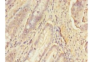 Immunohistochemistry of paraffin-embedded human colon cancer using ABIN7151689 at dilution of 1:100 (ERGIC1 antibody  (AA 48-254))