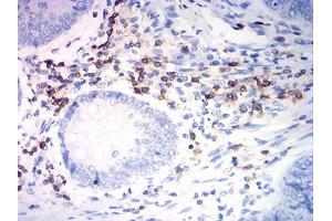 Immunohistochemical analysis of paraffin-embedded rectum cancer tissues using CD7 mouse mAb with DAB staining.