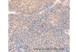 Immunohistochemistry of Human thyroid cancer using CD109 Polyclonal Antibody at dilution of 1:30