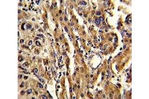IHC analysis of FFPE human hepatocarcinoma stained with ABCG1 antibody (ABCG1 antibody  (AA 359-387))