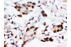 Immunohistochemical analysis of paraffin embedded cancer sections, staining in nucleus, DAB chromogenic reaction
