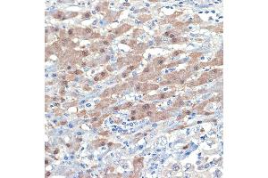 Immunohistochemistry of paraffin-embedded human liver cancer using [KO Validated] Smad4 Rabbit mAb (ABIN7270340) at dilution of 1:100 (40x lens). (SMAD4 antibody)