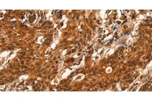 Immunohistochemistry of paraffin-embedded Human gastric cancer using CUEDC2 Polyclonal Antibody at dilution of 1:50 (CUEDC2 antibody)
