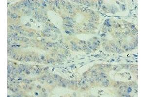 Immunohistochemistry of paraffin-embedded human colon cancer using ABIN7159411 at dilution of 1:100 (MEP1A antibody  (AA 440-700))