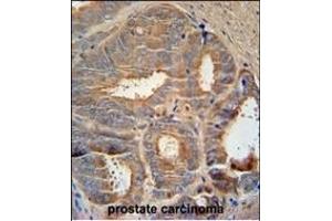 AZGP1 Antibody (N-term) (ABIN390565 and ABIN2840895) immunohistochemistry analysis in formalin fixed and paraffin embedded human prostate carcinoma followed by peroxidase conjugation of the secondary antibody and DAB staining. (AZGP1 antibody  (N-Term))