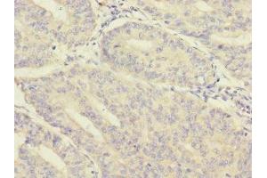 Immunohistochemistry of paraffin-embedded human endometrial cancer using ABIN7160214 at dilution of 1:100 (MORN5 antibody  (AA 1-161))