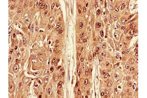 Immunohistochemistry of paraffin-embedded human cervical cancer using ABIN7174538 at dilution of 1:100 (ATG7 antibody  (AA 386-676))