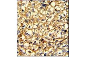 Formalin-fixed and paraffin-embedded human breast carcinoma with ADRA2B Antibody (Center), which was peroxidase-conjugated to the secondary antibody, followed by DAB staining. (ADRA2B antibody  (AA 349-378))