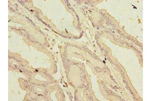 Immunohistochemistry of paraffin-embedded human prostate cancer using ABIN7144619 at dilution of 1:100 (ARMCX1 antibody  (AA 29-300))