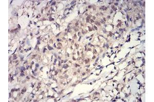 Immunohistochemical analysis of paraffin-embedded breast cancer tissues using HIST2H3C(27Ac) mouse mAb with DAB staining. (Histone Cluster 2, H3c (HIST2H3C) (acLys27) antibody)