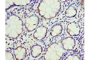 Immunohistochemistry of paraffin-embedded human colon cancer using ABIN7146792 at dilution of 1:100 (CEACAM3 antibody  (AA 1-135))
