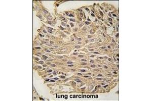 Formalin-fixed and paraffin-embedded human lung carcinoma tissue reacted with ALDOA antibody (C-term) (ABIN389192 and ABIN2839355) , which was peroxidase-conjugated to the secondary antibody, followed by DAB staining. (ALDOA antibody  (C-Term))