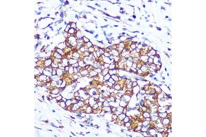 Immunohistochemistry of paraffin-embedded human esophageal cancer using Pannexin 1 Rabbit mAb (ABIN7269168) at dilution of 1:100 (40x lens). (PANX1 antibody)