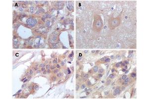 Immunohistochemical analysis of paraffin-embedded human ovary carcinoma (A), normal cerebrum tissue (B), breast infiltrating carcinoma (C) and breast infiltrating carcinoma (D), showing cytoplasmic localization.