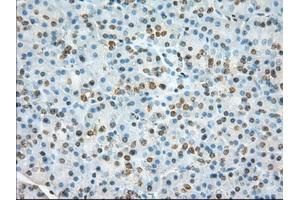 Immunohistochemical staining of paraffin-embedded Adenocarcinoma of colon tissue using anti-TACC3 mouse monoclonal antibody. (TACC3 antibody)