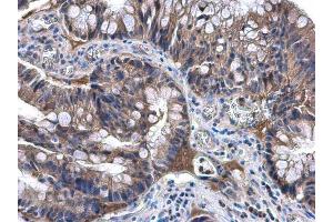 IHC-P Image NAT1 antibody [N1C1] detects NAT1 protein at cytoplasm in human colon carcinoma by immunohistochemical analysis.