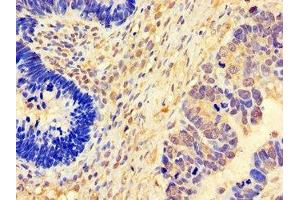 Immunohistochemistry of paraffin-embedded human ovarian cancer using ABIN7152824 at dilution of 1:100 (FGF8 antibody  (AA 23-143))