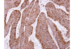 IHC-P Image Immunohistochemical analysis of paraffin-embedded human colon carcinoma, using OSGEP, antibody at 1:500 dilution. (OSGEP antibody)