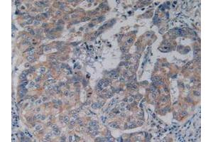 IHC-P analysis of Human Breast Cancer Tissue, with DAB staining. (NFkB antibody  (AA 805-892))