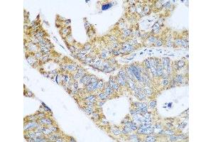 Immunohistochemistry of paraffin-embedded Human colon carcinoma using GLUD1 Polyclonal Antibody at dilution of 1:100 (40x lens).