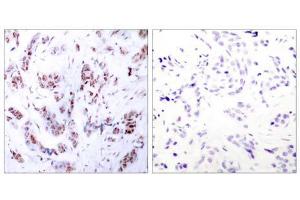 Immunohistochemical analysis of paraffin-embedded human breast carcinoma tissue using MEF2A (Ab-312) antibody (E021039). (MEF2A antibody)