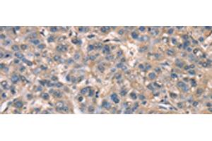 Immunohistochemistry of paraffin-embedded Human liver cancer tissue using ZFYVE19 Polyclonal Antibody at dilution of 1:60(x200) (ZFYVE19 antibody)