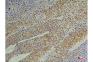 Immunohistochemistry (IHC) analysis of paraffin-embedded Human Heptacarcinoma using Cyclophilin B Mouse Monoclonal Antibody diluted at 1:200. (PPIB antibody)