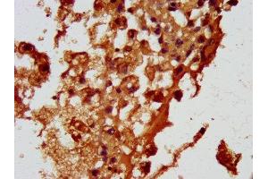 IHC image of ABIN7164700 diluted at 1:100 and staining in paraffin-embedded human melanoma performed on a Leica BondTM system. (HBEGF antibody  (AA 63-148))