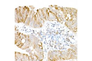 Immunohistochemistry of paraffin-embedded human colon carcinoma using USP18 Rabbit pAb (ABIN7271145) at dilution of 1:25 (40x lens).