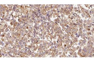 ABIN6278895 at 1/100 staining Human Melanoma tissue by IHC-P. (IL17F antibody  (Internal Region))