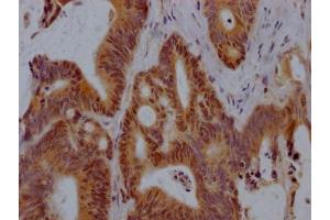 IHC image of ABIN7127869 diluted at 1:100 and staining in paraffin-embedded human colon cancer performed on a Leica BondTM system. (Recombinant Vitamin D Receptor antibody)